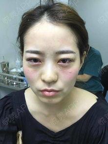 手术去眼袋视频,专业视角下的美丽蜕变