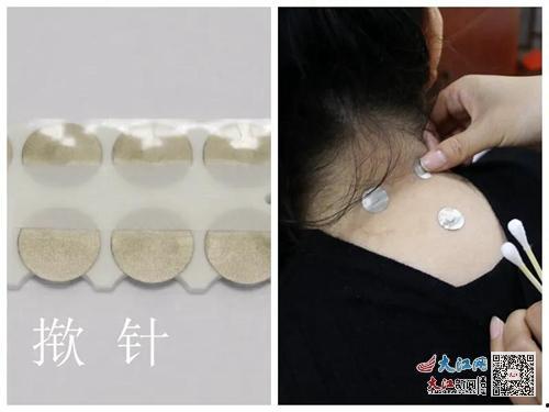 揿针使用视频,轻松掌握家庭养生新技能